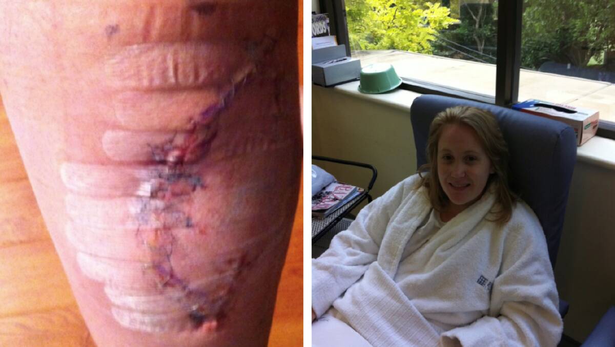 Sam Coyle pictured during treatment in 2011 and (left) her melanoma scar. Pictures supplied
